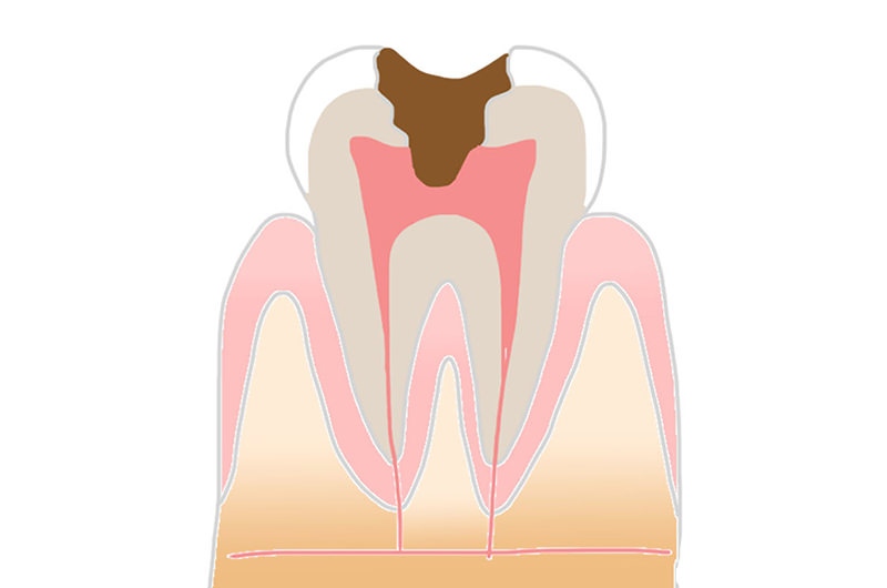 C3　歯髄炎、根尖性歯周炎